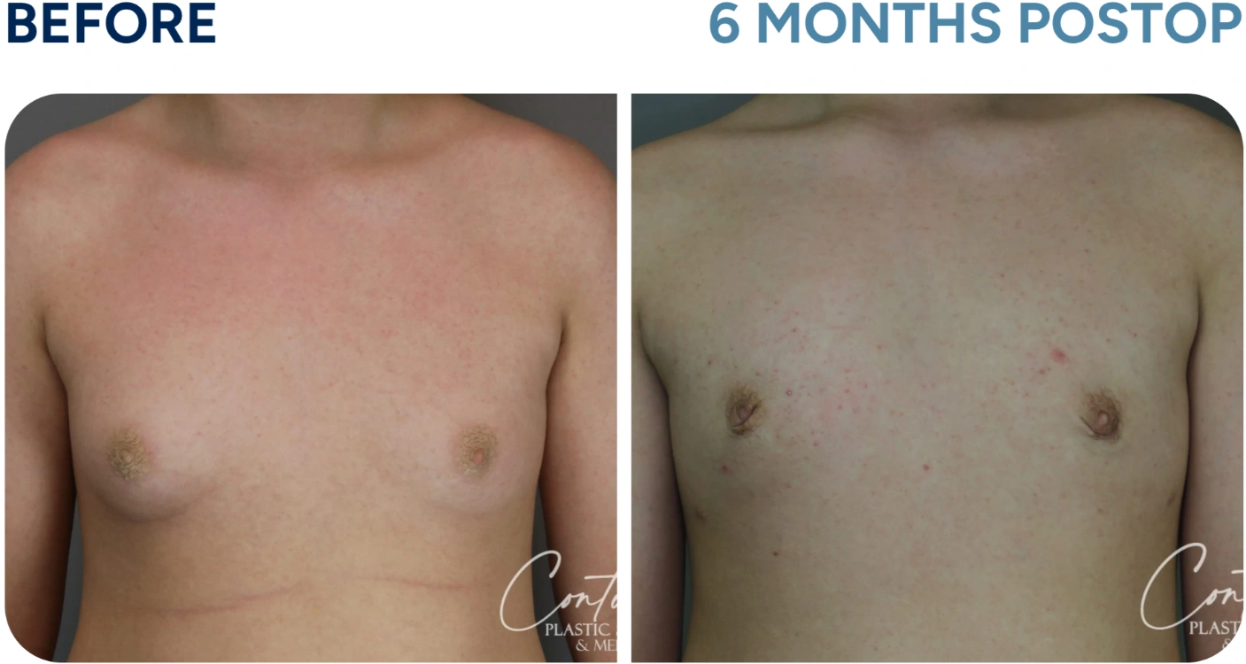 before and after gynecomastia before and after gynecomastia