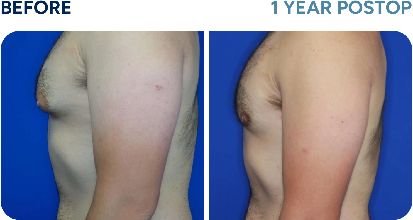 before and after gynecomastia before and after gynecomastia