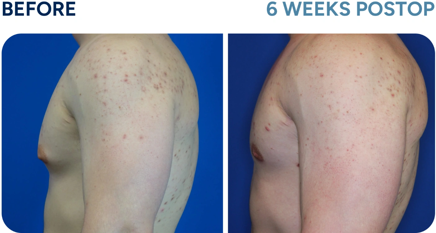 before and after gynecomastia before and after gynecomastia