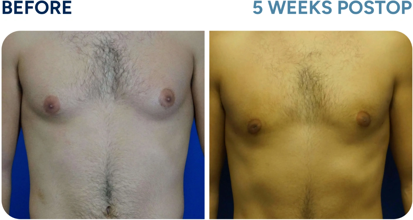 before and after gynecomastia before and after gynecomastia