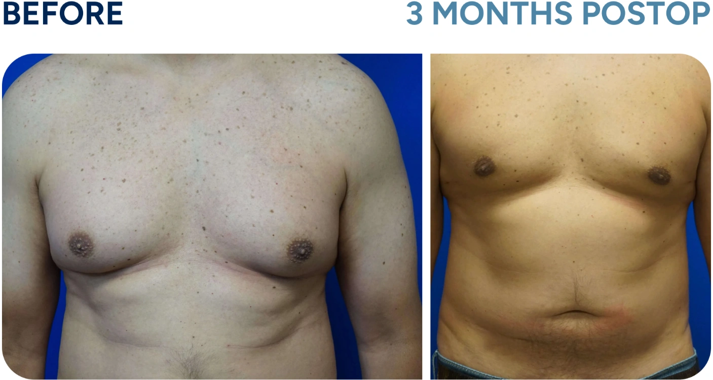 before and after gynecomastia before and after gynecomastia