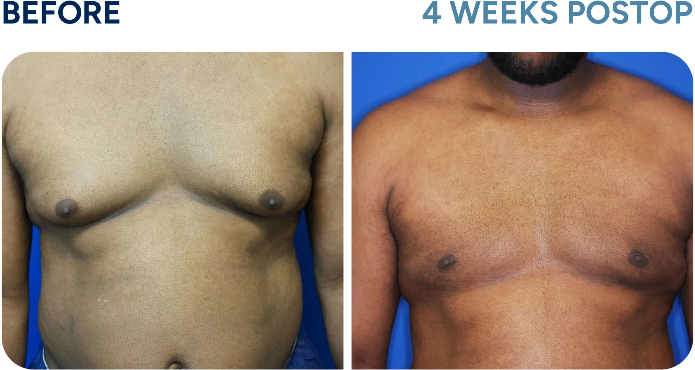 before and after gynecomastia before and after gynecomastia