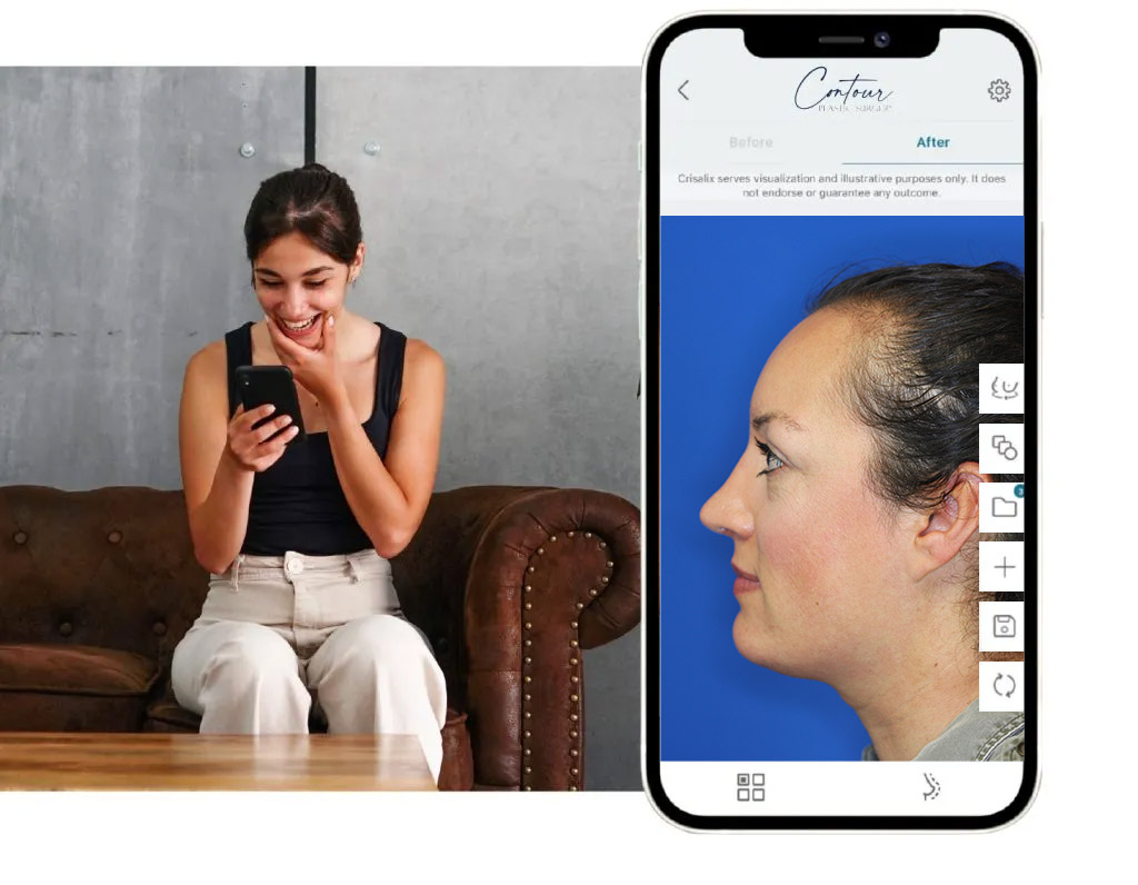 Crisalix 3D phone mockup for Rhinoplasty