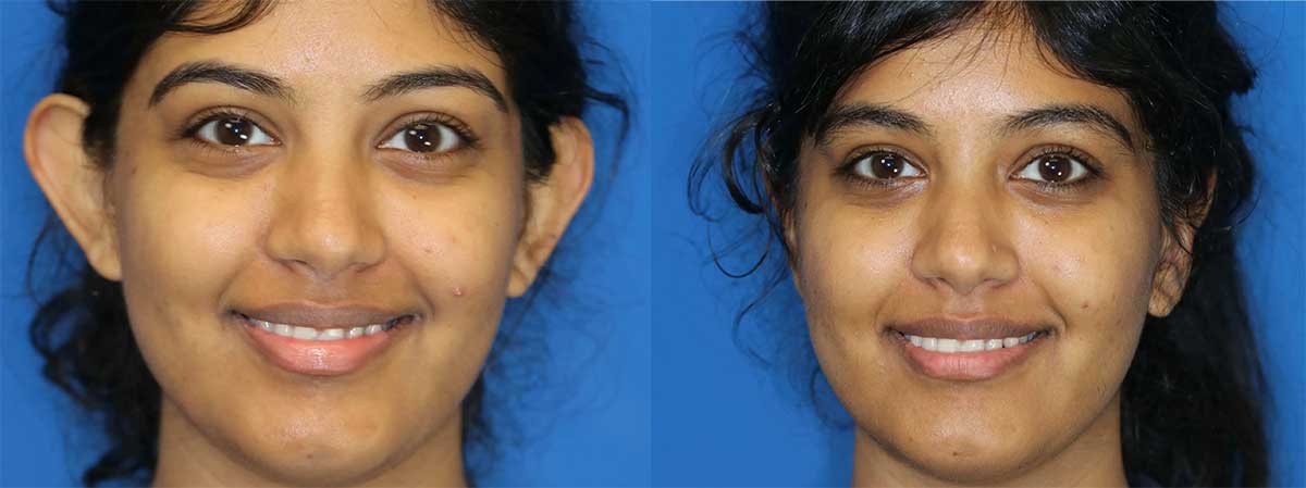 ear surgery before and after patient four ear surgery before and after patient four