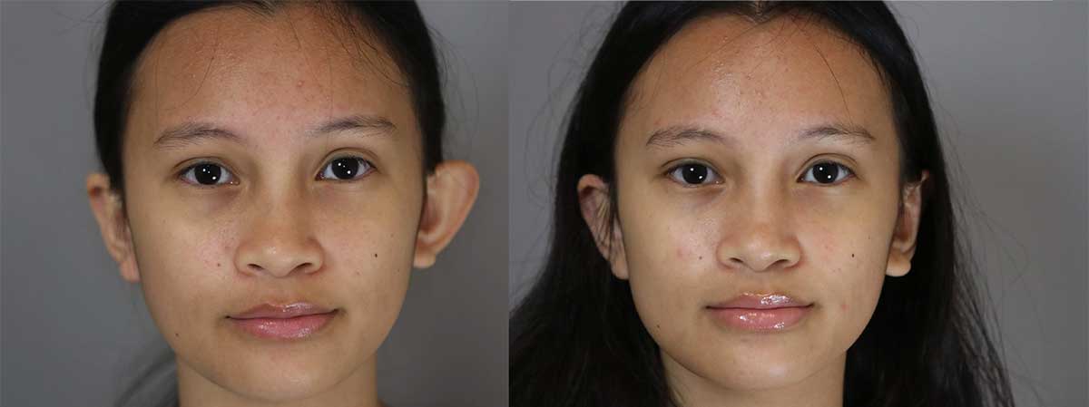 ear surgery before and after patient one ear surgery before and after patient one