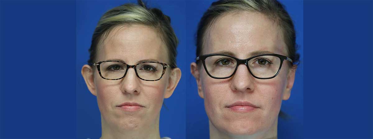 ear surgery before and after patient three ear surgery before and after patient three