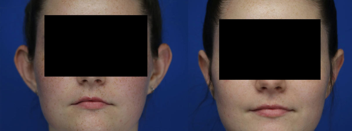 eary surgery patient before and after image eary surgery patient before and after image