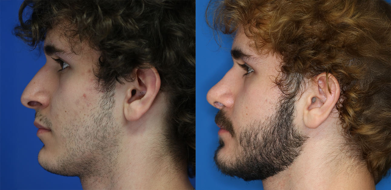 rhinoplasty patient before and after photo rhinoplasty patient before and after photo