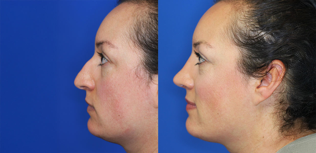 rhinoplasty patient before and after photo rhinoplasty patient before and after photo