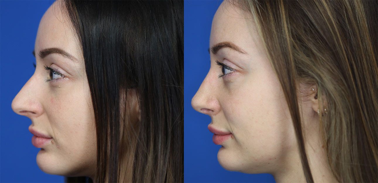 rhinoplasty patient before and after photo rhinoplasty patient before and after photo