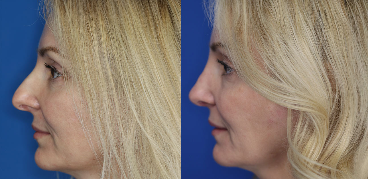rhinoplasty patient before and after photo rhinoplasty patient before and after photo