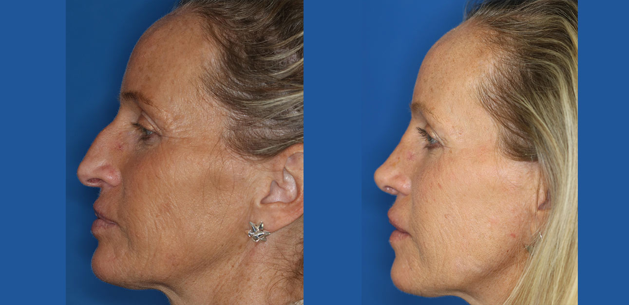 rhinoplasty patient before and after photo rhinoplasty patient before and after photo