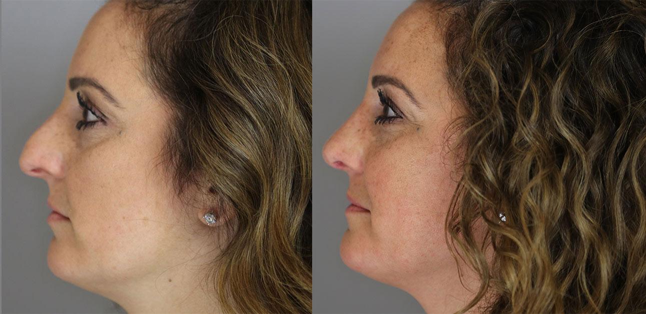 rhinoplasty patient before and after photograph rhinoplasty patient before and after photograph